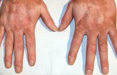 手部白癜风的早期症状是什么