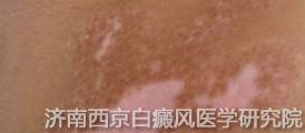 你还不了解的白癜风类型