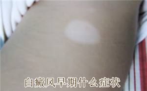 白癜风前期时候症状表现