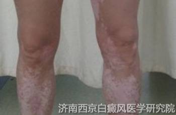 如何进行腿部白癜风预防