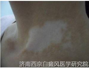 青少年白癜风是如何诊断的