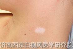 白癜风治不好的原因是什么