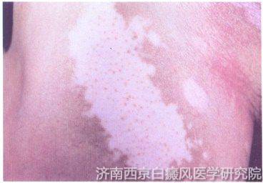 白癜风患者应该怎样预防护理