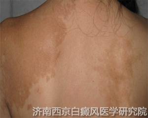 如何诊断背部是否患上白癜风