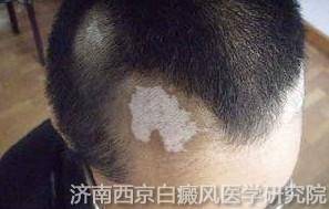 兰州白癜风医院哪家