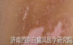 儿童白癜风病的症状