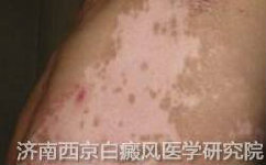 白癜风初期是什么样子