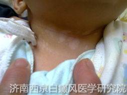 儿童白癜风怎么治疗