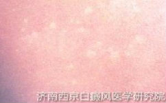小孩头上长白癜风怎么治疗
