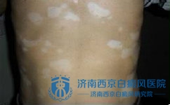 白癜风如何判断