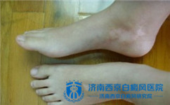 白癜风能否