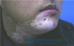 白癜风多久可以冶好