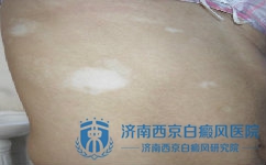 什么叫做白癜风