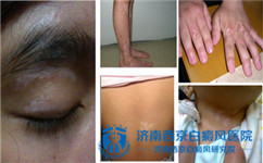 白癜风扩散的速度有多快?