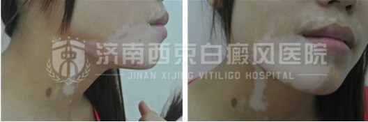 紫外线对白癜风都有哪些伤害?