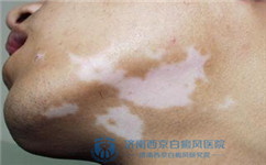 白癜风的症状有哪些