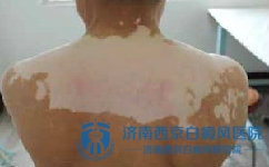 长时间不治疗白癜风有什么后果 长时间不治疗白癜风有什么后果