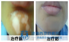 什么情况下容易诱发白癜风 什么情况下容易诱发白癜风