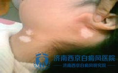 白癜风初期症状有哪些 白癜风初期症状有哪些