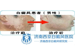 白癜风是什么原因导致的 白癜风是什么原因导致的