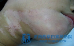 胸部患白癜风的原因 胸部患白癜风的原因
