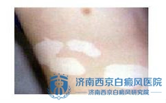 如何分辨白癜风周期 如何分辨白癜风周期
