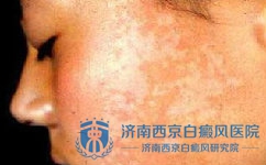 怎样才能避免白癜风的产生 怎样才能避免白癜风的产生