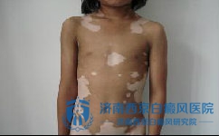 有什么方法可以让白癜风停止扩大 有什么方法可以让白癜风停止扩大