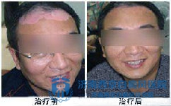 白癜风患者如何调整自己的情绪 白癜风患者如何调整自己的情绪