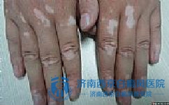 老年白癜风怎么治疗才好 老年白癜风怎么治疗才好