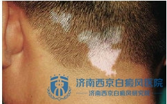 兰州哪家医院可以看白癜风 兰州哪家医院可以看白癜风