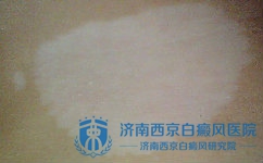 泛发型白癜风该如何饮食 泛发型白癜风该如何饮食