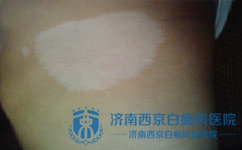 兰州哪里有的看白癜风的医院 兰州哪里有的看白癜风的医院
