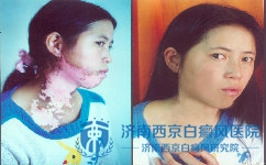 偏方能女性白癜风吗 偏方能女性白癜风吗