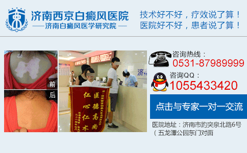 小孩容易长白癜风吗 小孩容易长白癜风吗