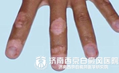 手指白癜风的症状及因素